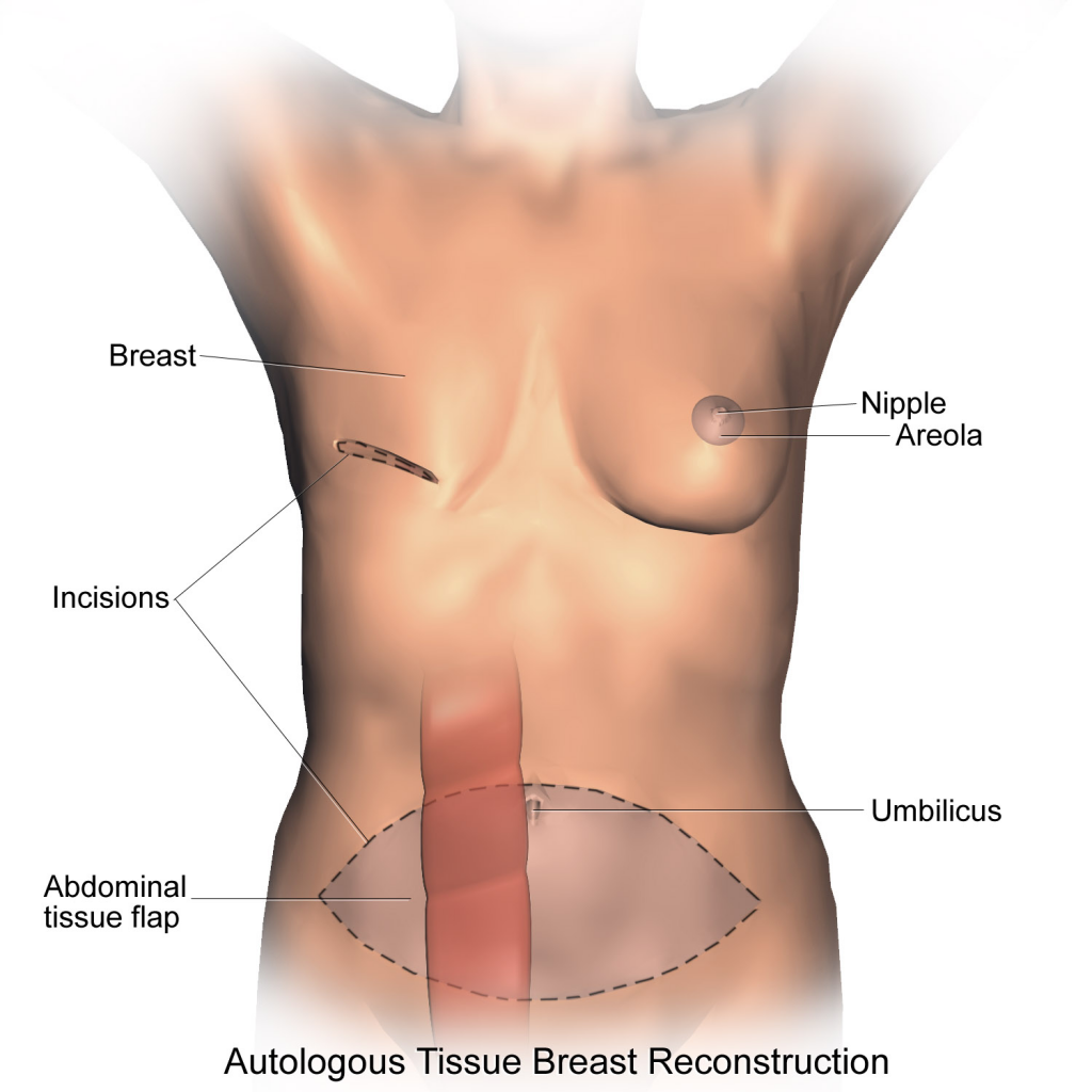 Breast Reconstruction 