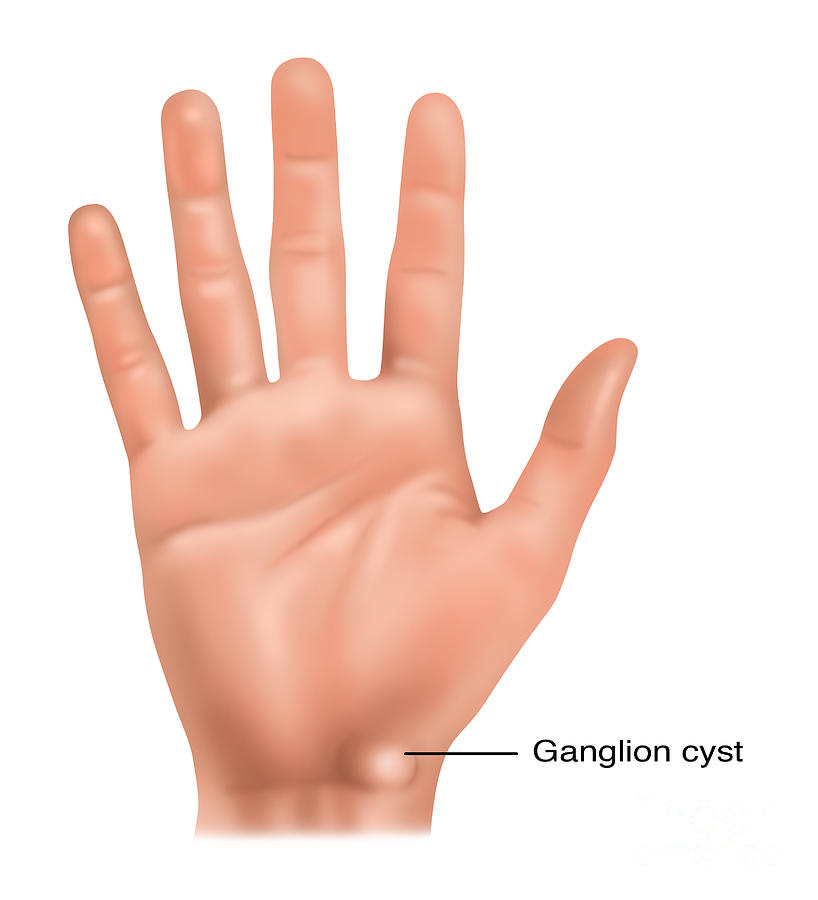 Damages of the Ganglion cyst in the Hand