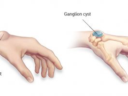 Damages of the Ganglion cyst in the Hand
