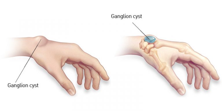 Damages Of The Ganglion Cyst In The Hand Eposts Newspaper Find And