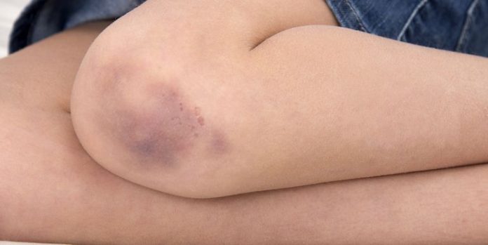 When Do Bruises Become Serious