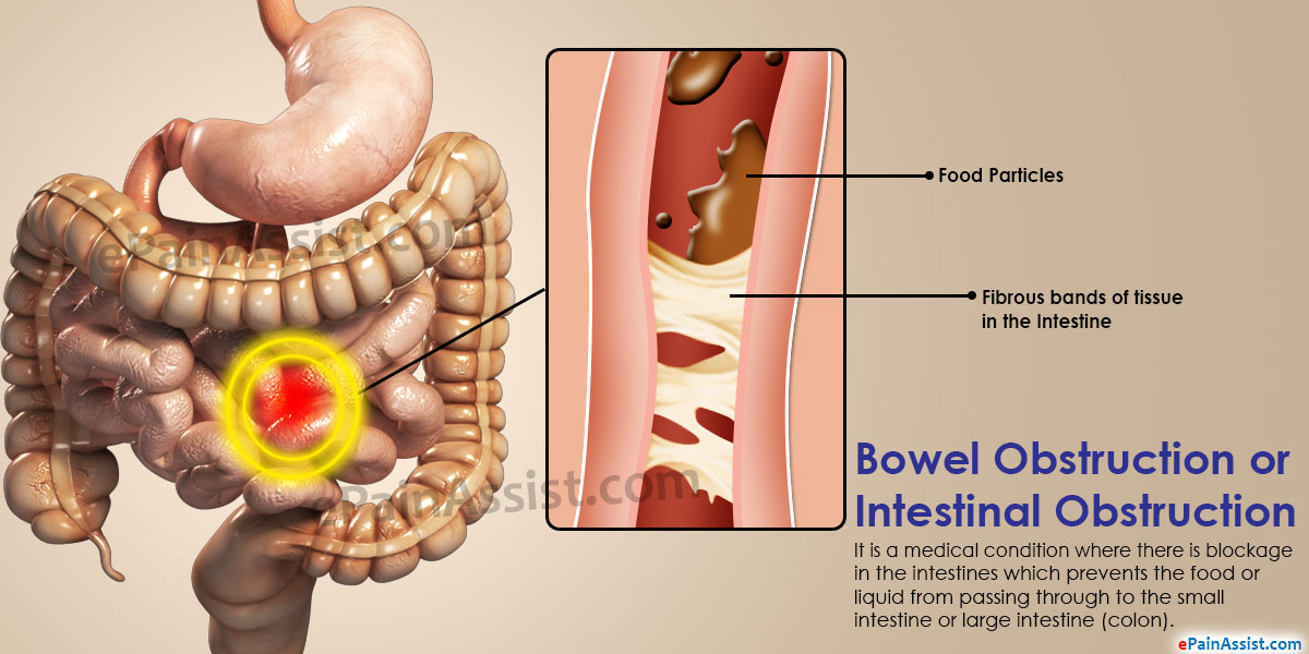 Tuberculos intestinales