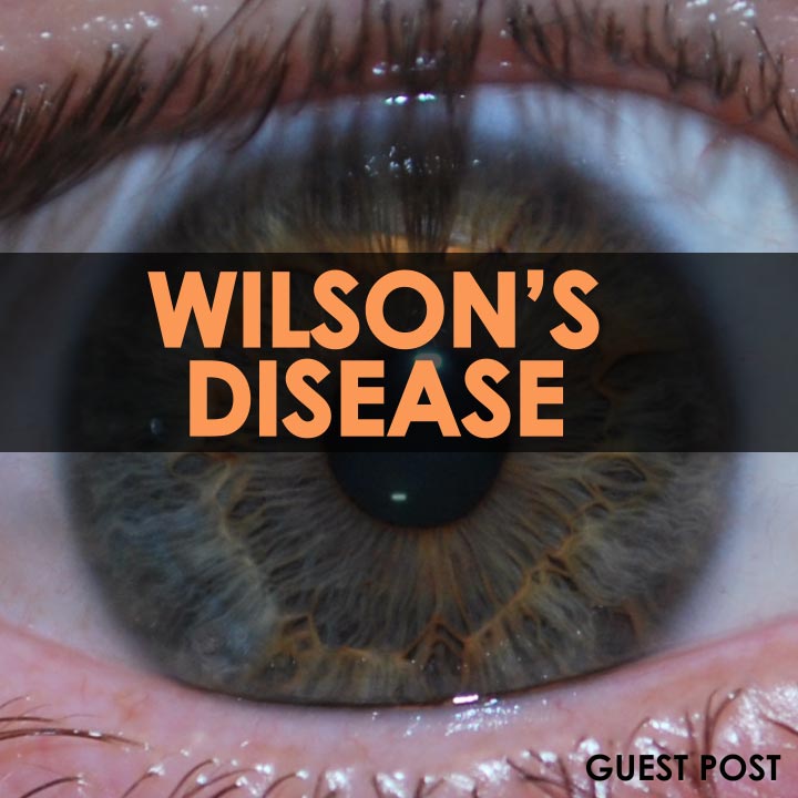 Wilson's Disease Causes and Symptoms | ePosts Newspaper - find and